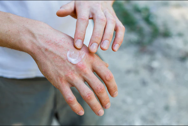 Cbd Lotion Allergic Reaction Review